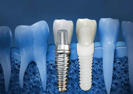 Dental implants Alexandria